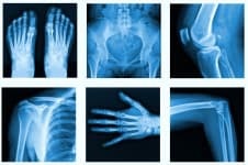Nahrungsergänzungsmittel gegen Arthrose und zum Knorpelaufbau
